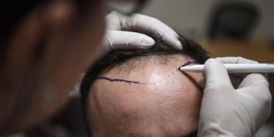 #وفاة رجل بعد خضوعه لعملية زرع شعر في عيادة #خاصة في مومباي